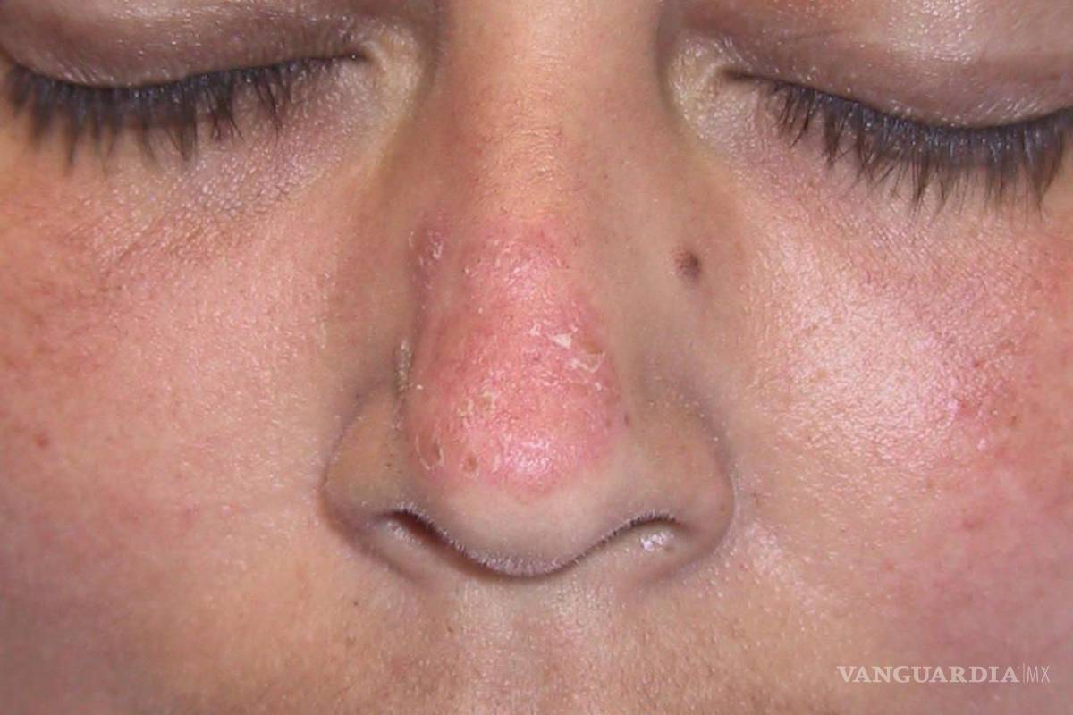 Lupus, la enfermedad silenciosa que ataca al sistema inmunológico