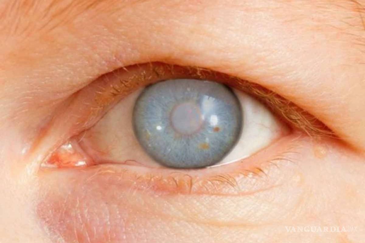 IMSS otorga más de 600 mil consultas por glaucoma