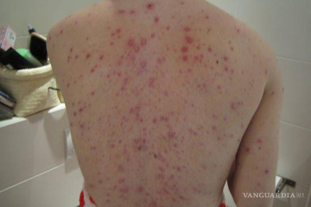 Se reportan 18 casos activos de varicela en Piedras Negras