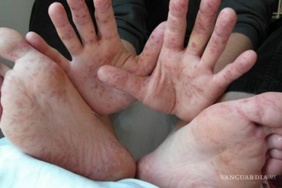 Coxsackie, el virus que está afectando a niños de Tlaxcala