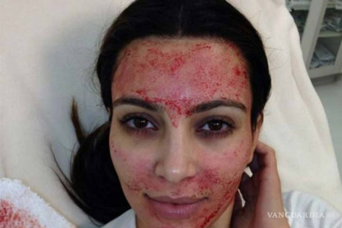 'Facial de vampiro' expone a las personas a contraer VIH