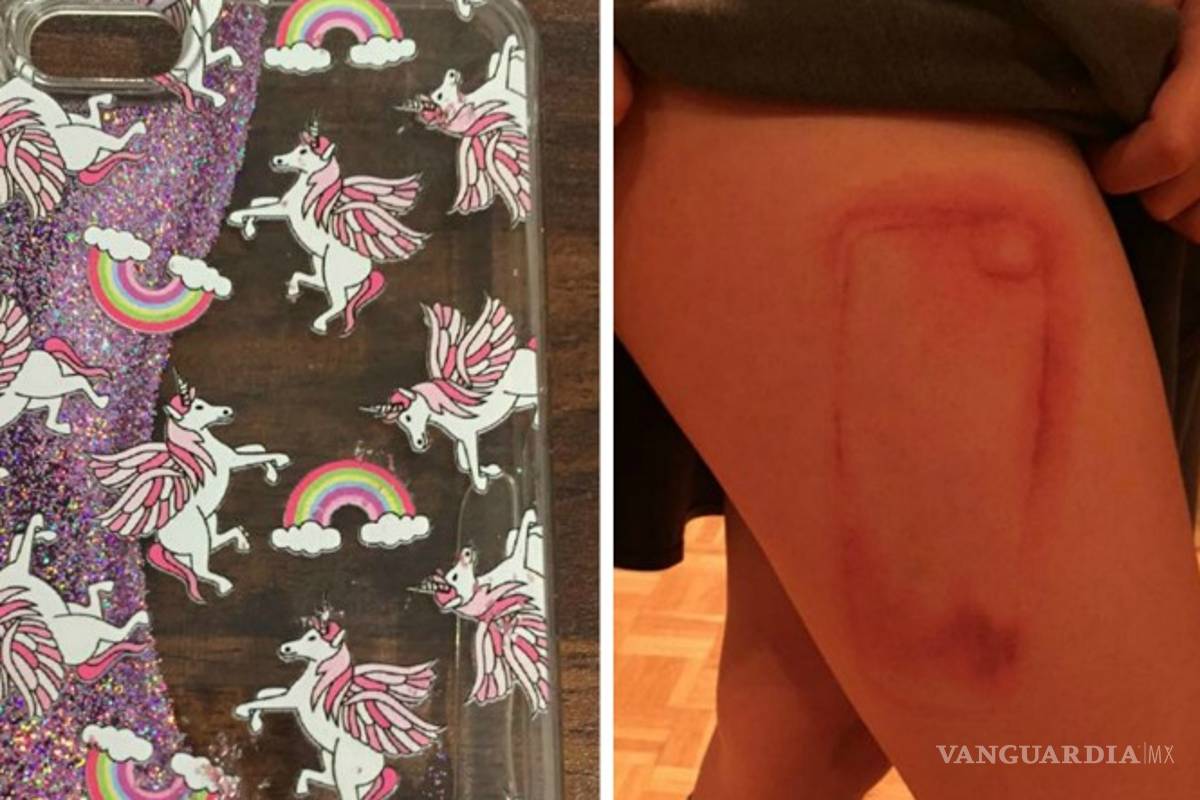 Niña sufre quemaduras por ponerse un iPhone sobre la pierna