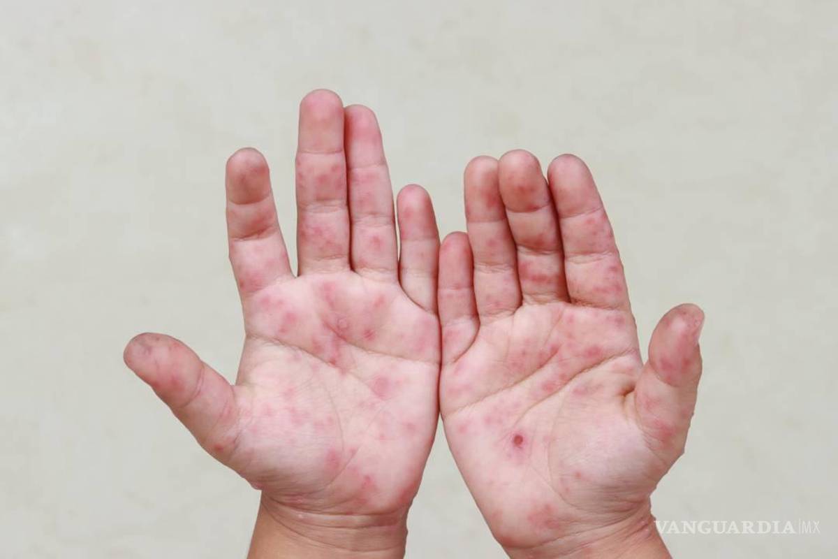 POLITICÓN: Alerta sanitaria: Aplica colegio de Saltillo medidas ante posible brote de ‘manos, pies y boca’