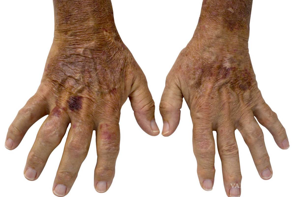 Esclerodermia, ¿sabe cómo afecta al organismo?