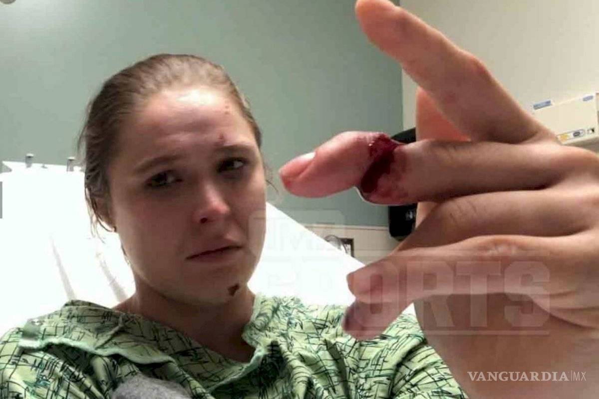 $!Ronda Rousey a punto de perder el dedo en México (foto)