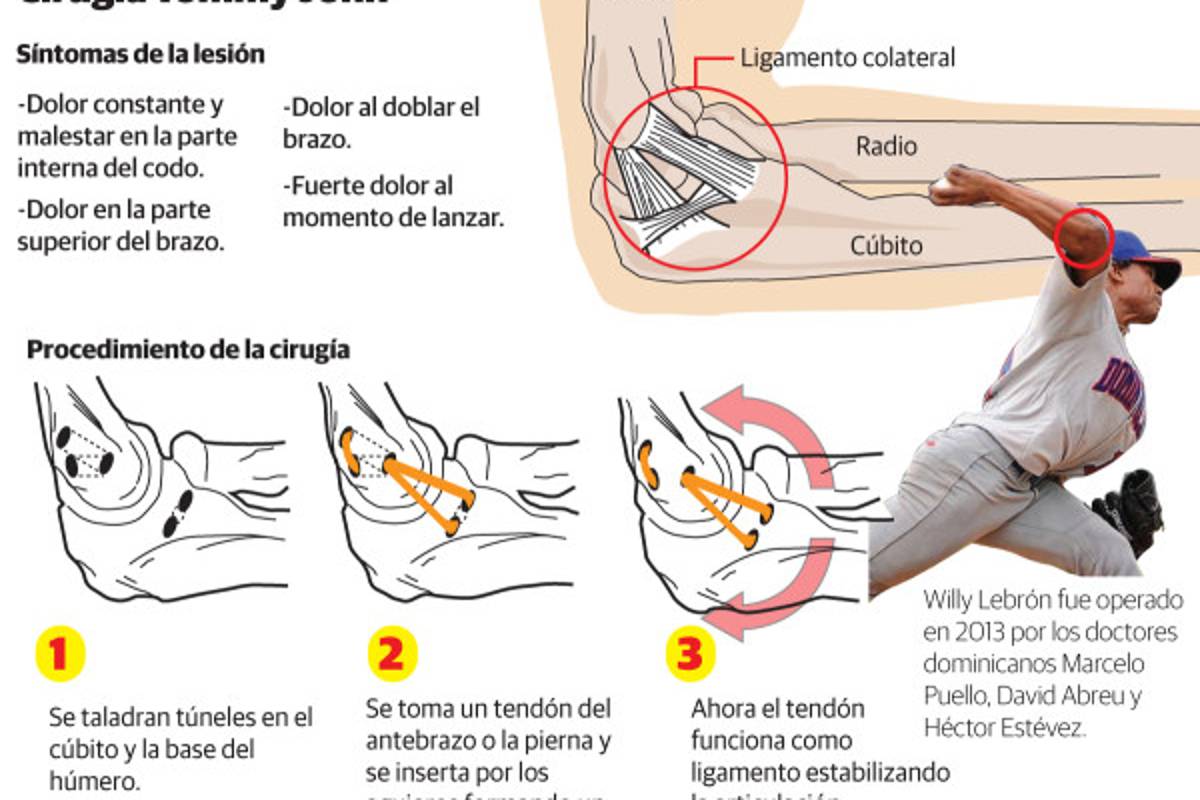La primera cirugía Tommy John