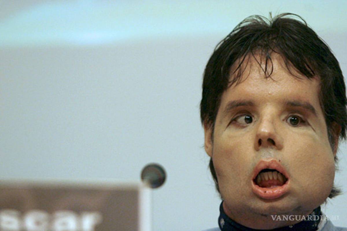 Muestra su rostro el primer trasplante completo de cara en el mundo