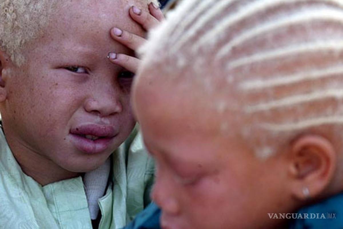 Albinismo afecta a uno de cada 50 mil bebés