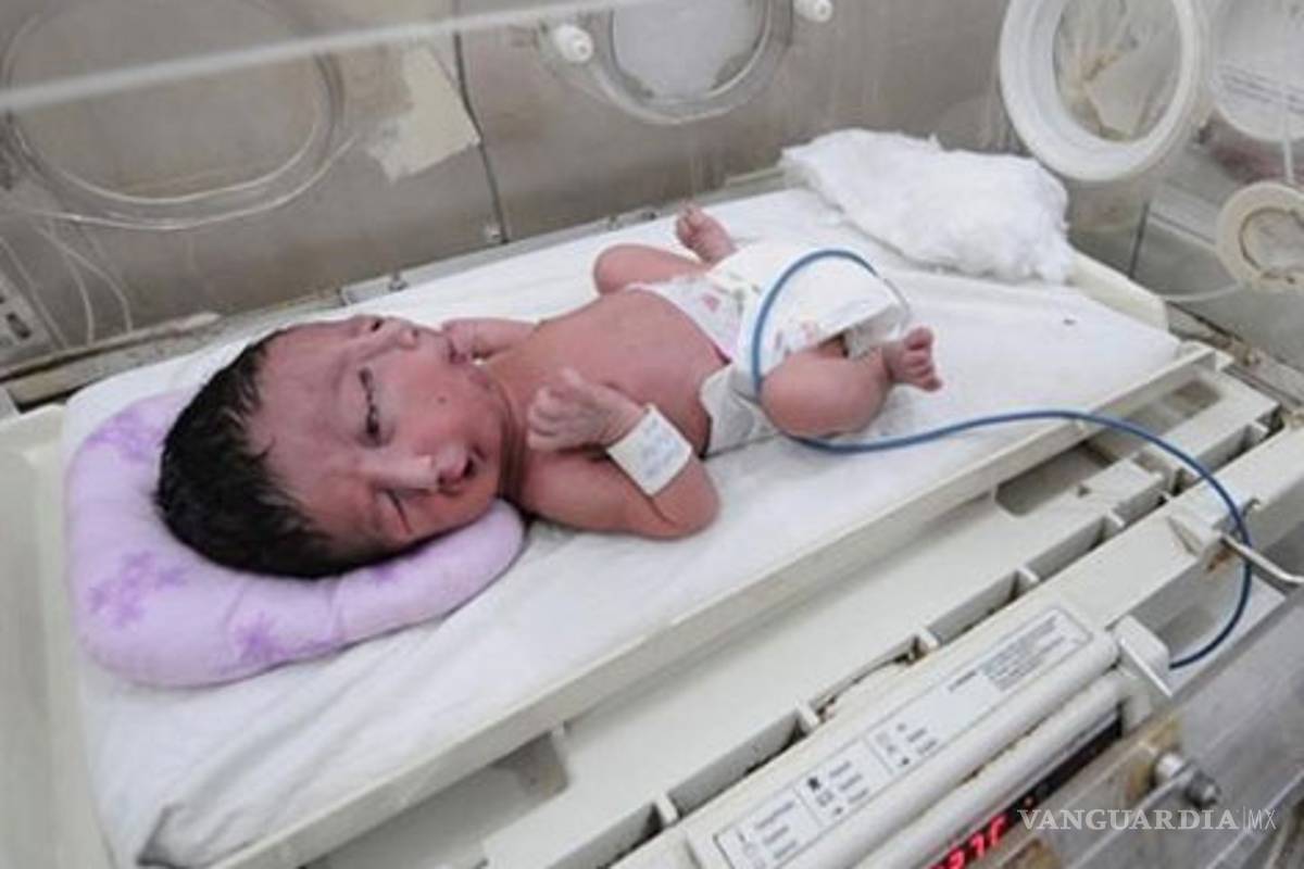 Nace en Pakistán bebé con dos caras y una cabeza