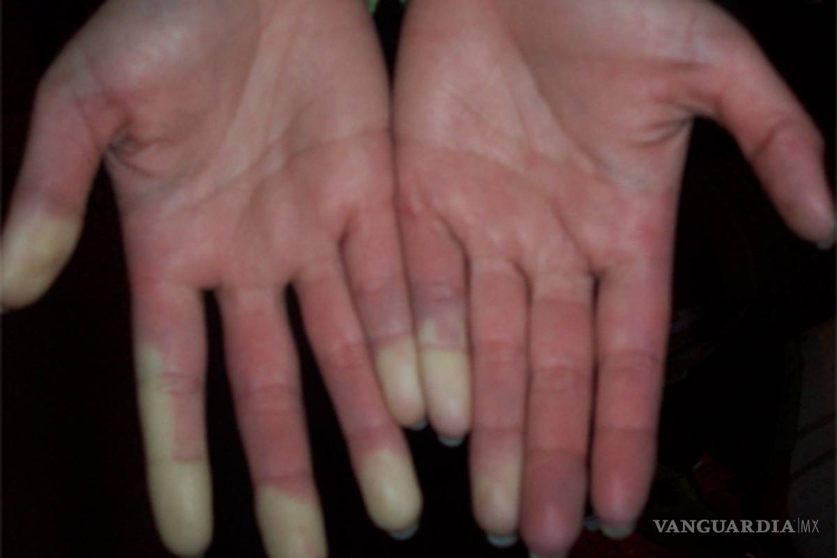 ¿Qué es la enfermedad mixta del tejido conjuntivo?