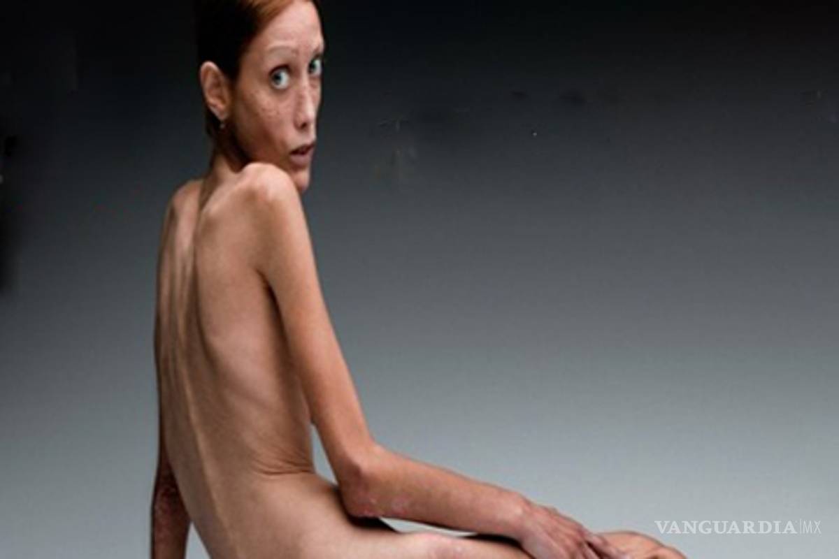 Muere modelo que luchó contra la anorexia