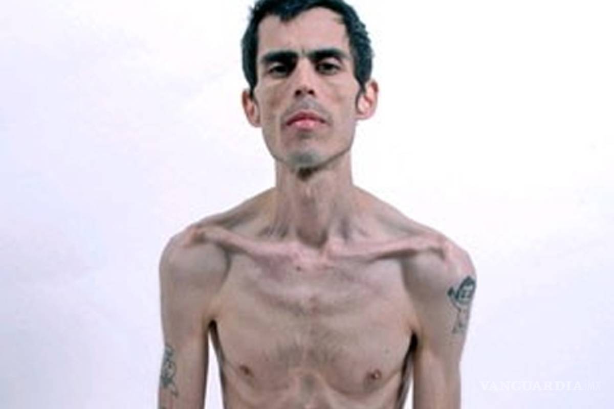 En México aumentan los casos de anorexia y bulimia en hombres