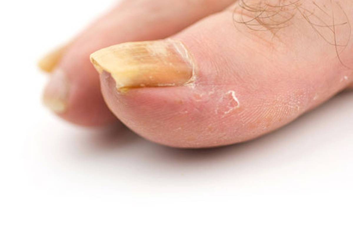 Cuidado con las infecciones por hongos en la tercera edad