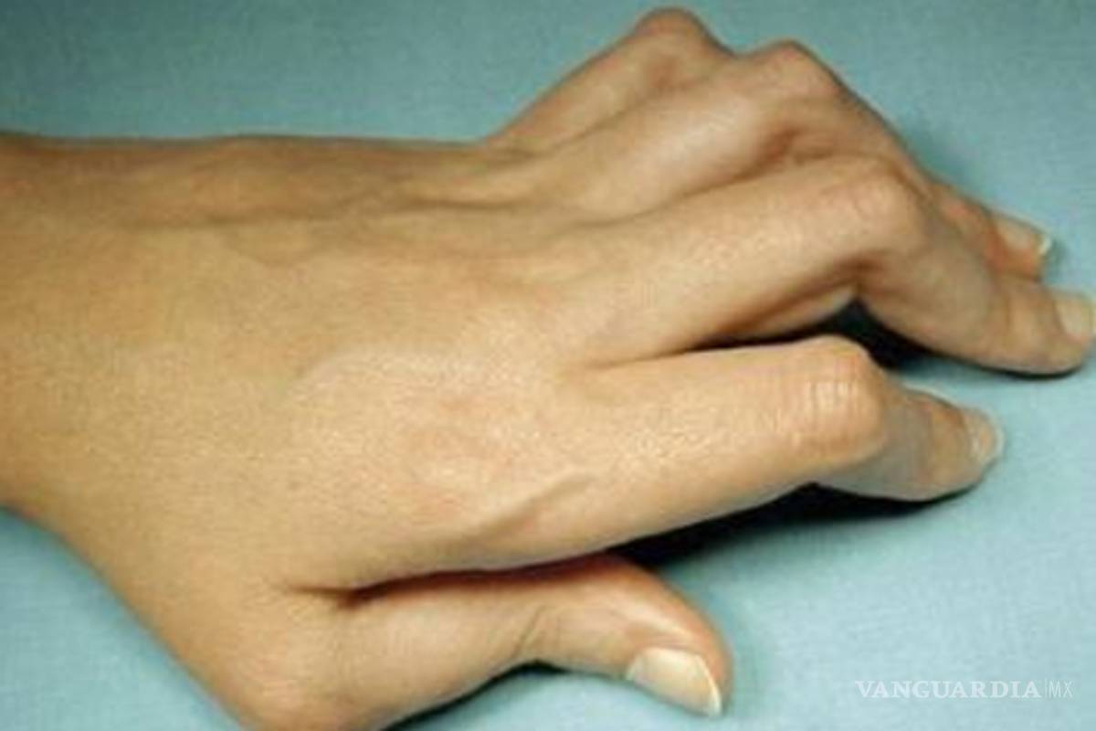 ¿Qué es la artritis reumatoide?