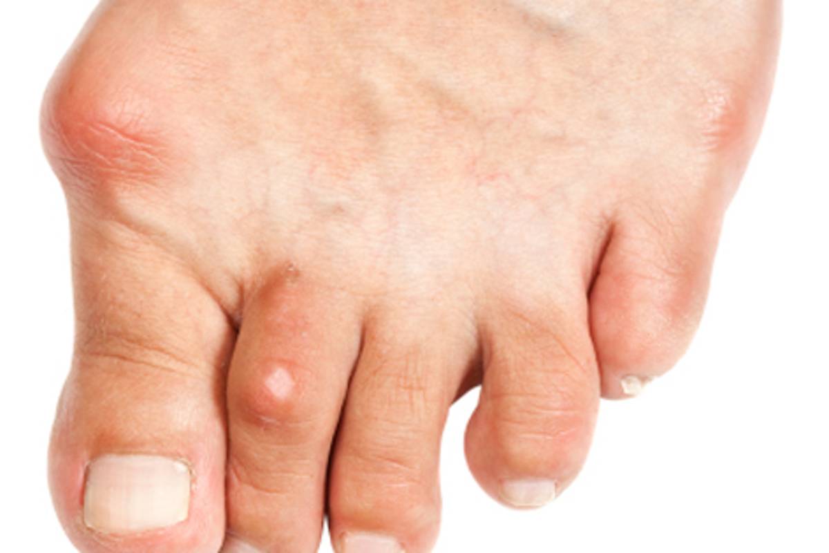 Alertan de síntomas de la denominada gota