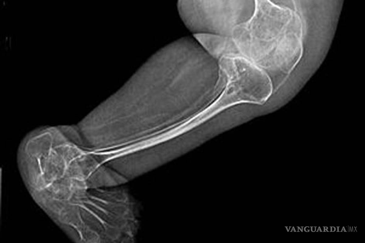 Identifican gen que causa <EM>huesos de cristal</EM>