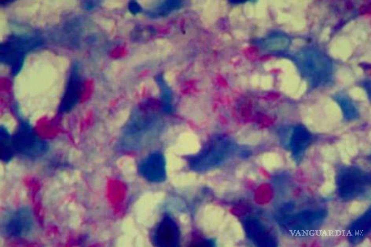 Células cancerosas, sensibles a quimioterapia gracias a anticuerpos de lupus