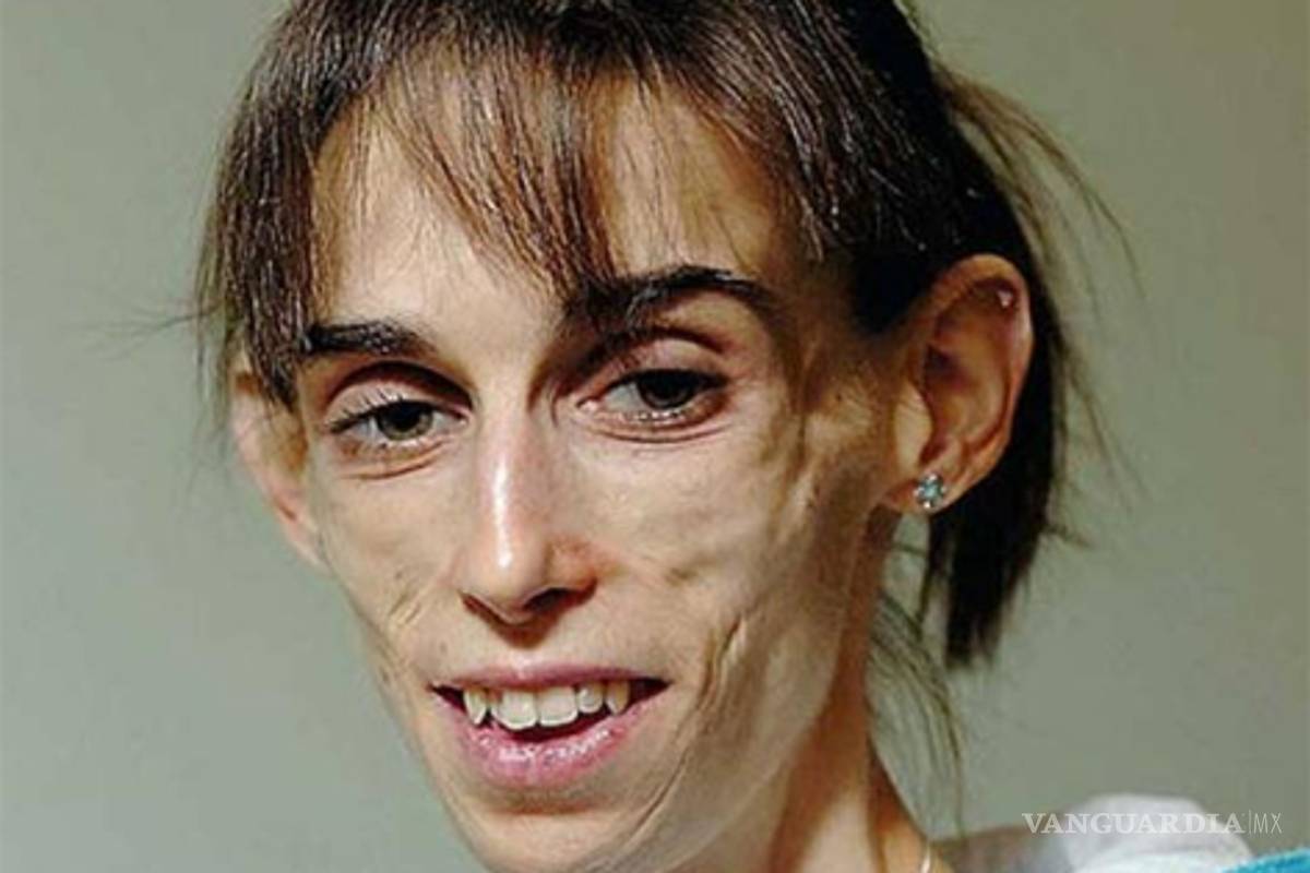 Muere la mujer con el peor caso de anorexia en el mundo