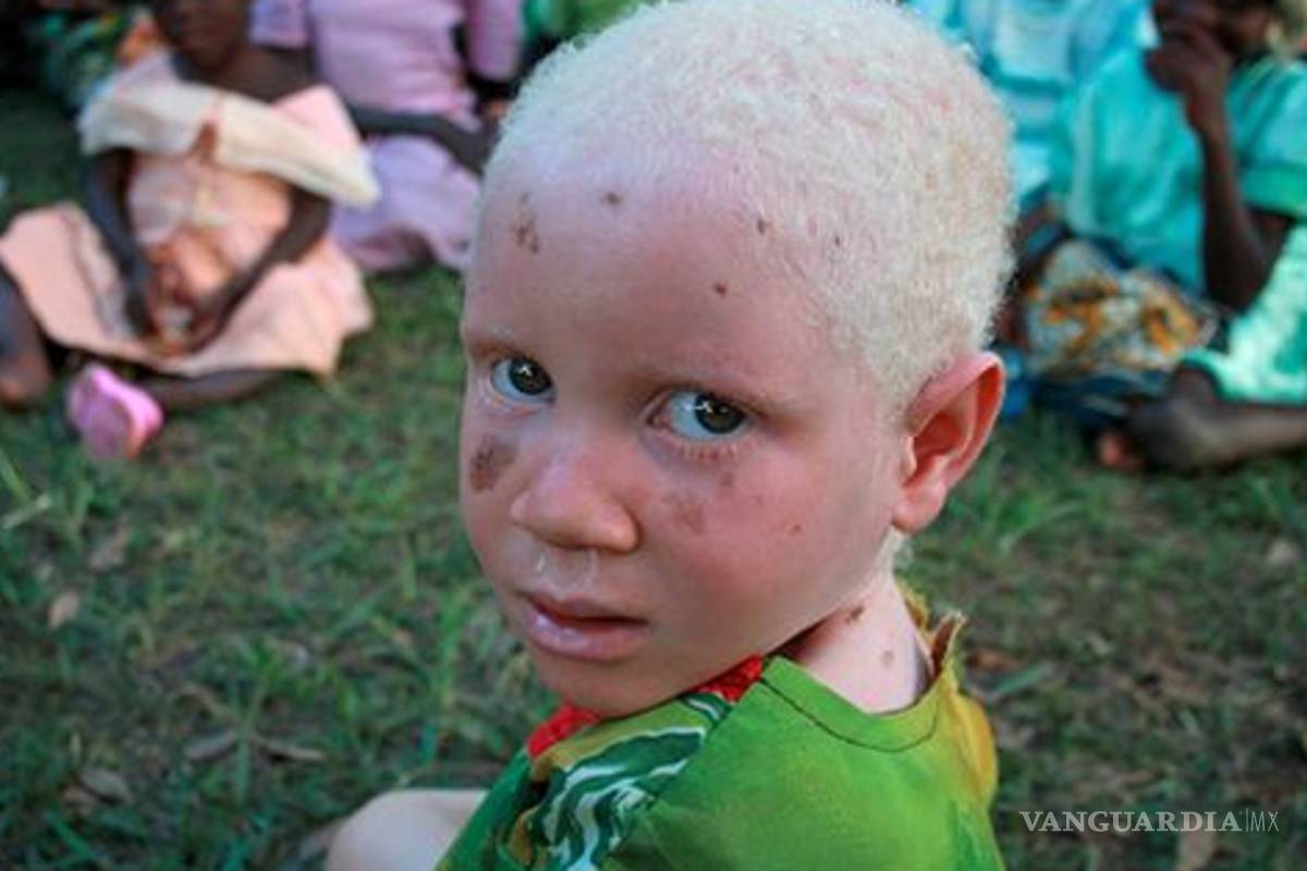 Albinos vulnerables a padecer cáncer