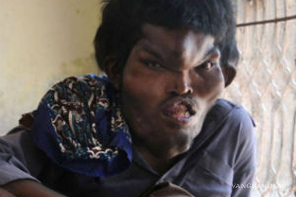 Joven batalla contra extraña enfermedad que lo ha deformado