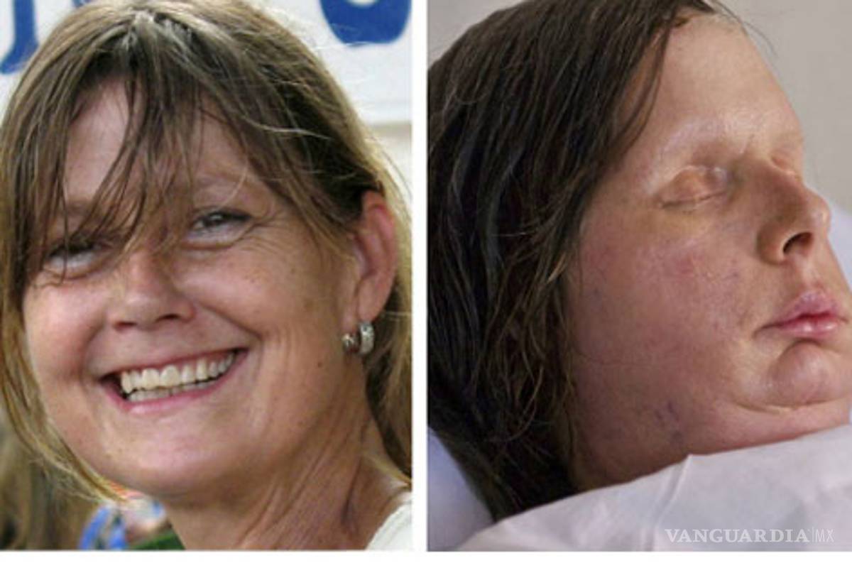 Elogian en EU nuevo rostro de mujer desfigurada por chimpancé