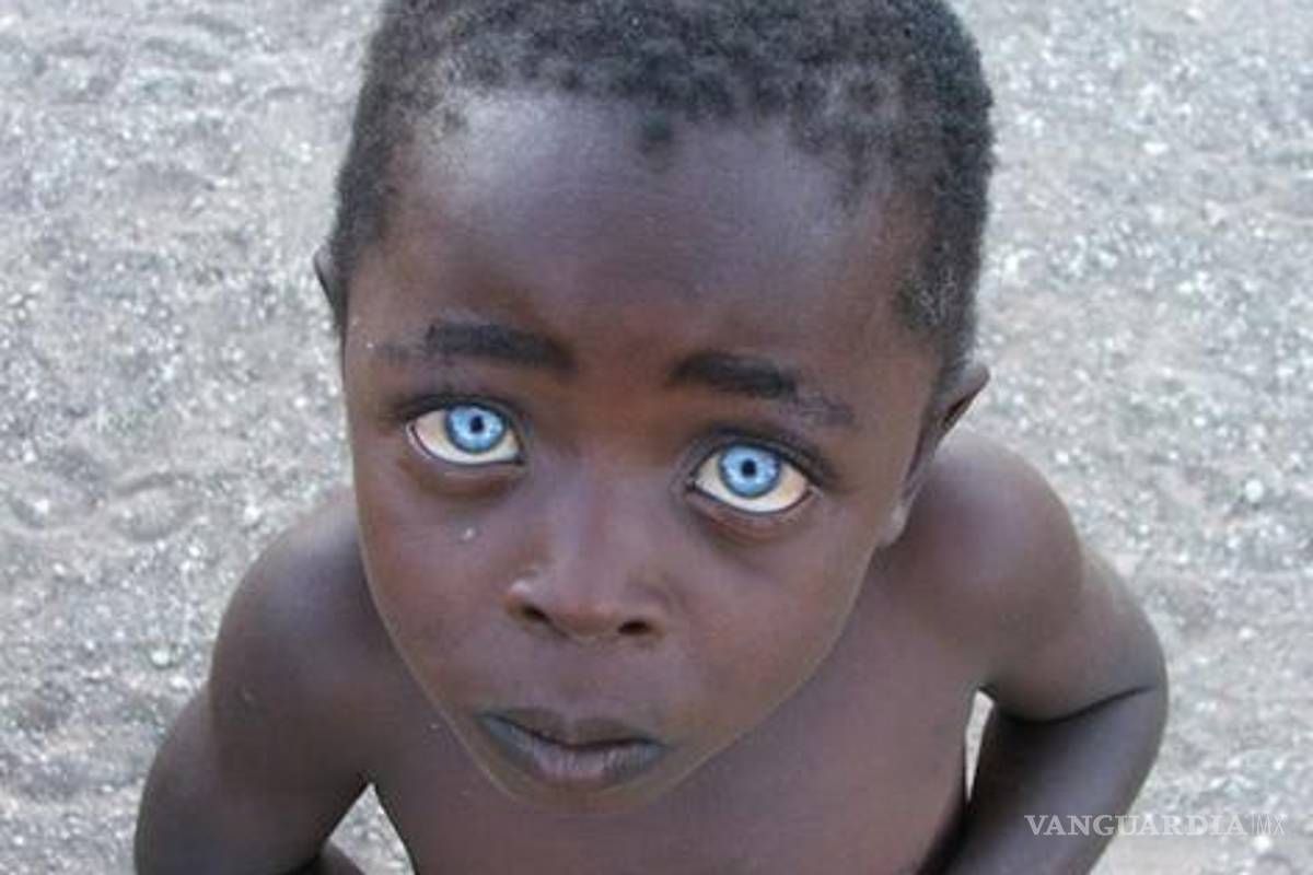 Niño africano con ojos de zafiro sorprende al mundo
