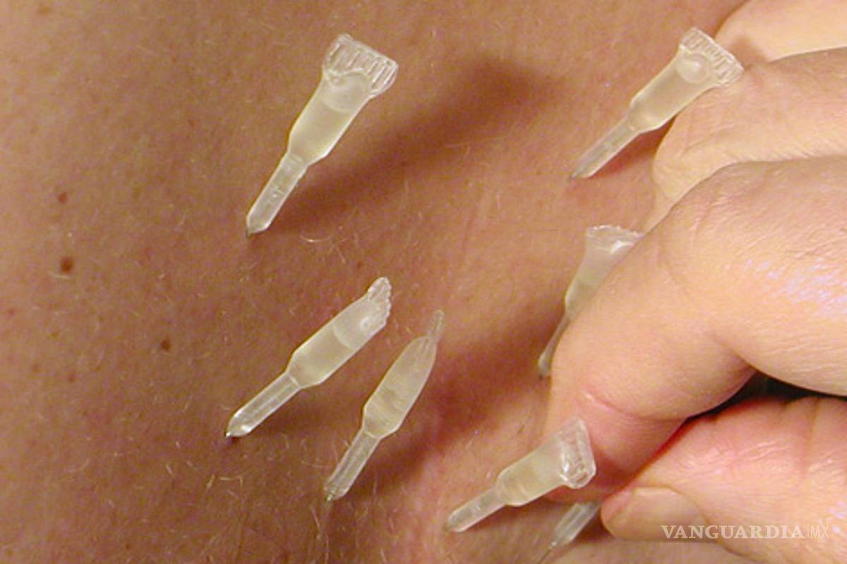 Acupuntura, método eficaz para tratar la disfunción eréctil