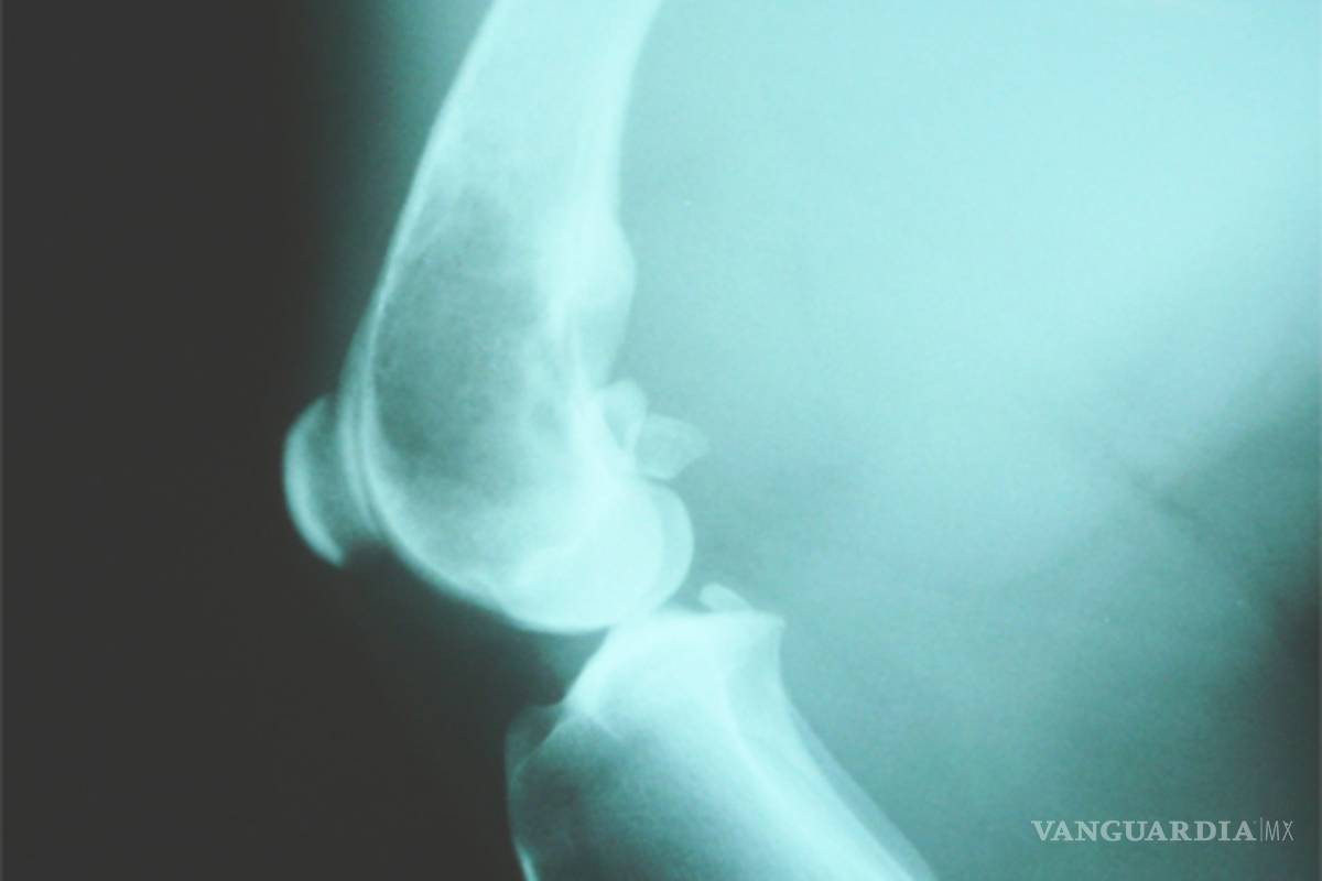 Riesgos y síntomas del Osteosarcoma