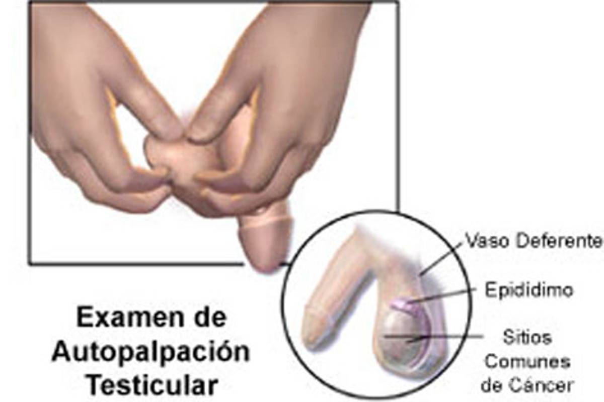 Cáncer testicular afecta a jóvenes