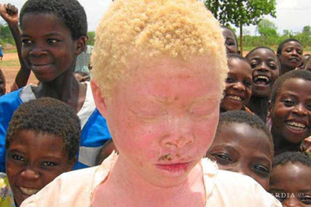 En Tanzania violan y asesinan personas albinas "para curar el sida"