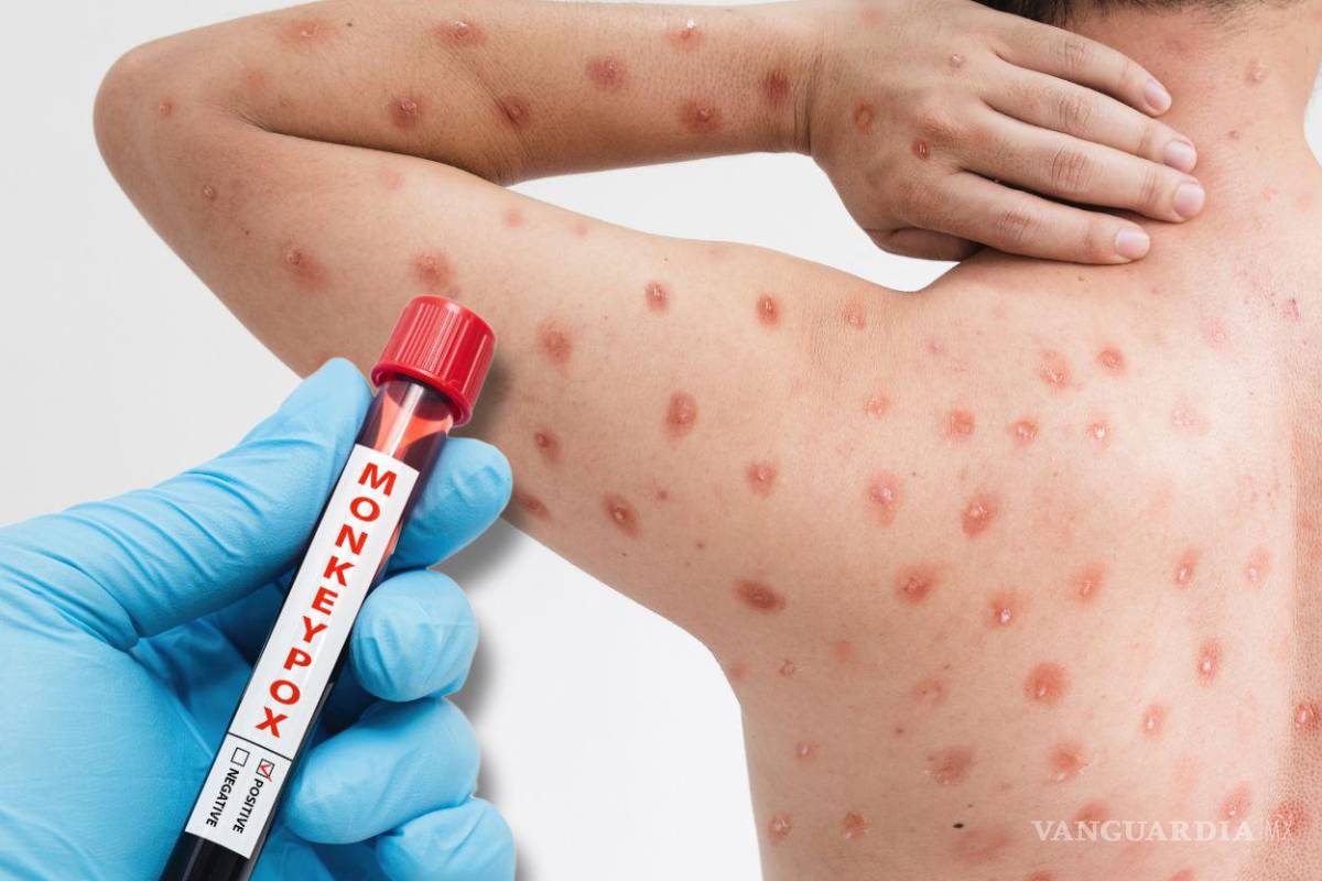 OMS alerta por brote mpox: ¿Cómo se contagia la viruela del mono? Así puedes prevenirla