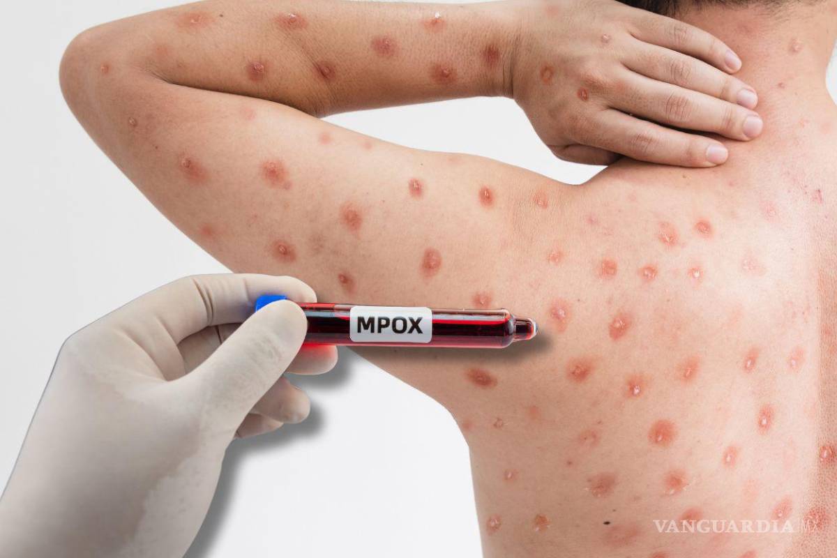 Confirman primer caso en 2024 de Mpox en Baja California Sur en joven de 26 años