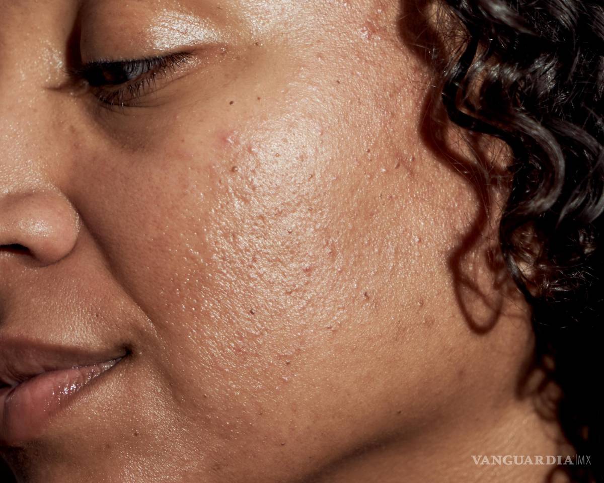 $!Si notas cicatrices o manchas oscuras en tus brotes o si tu acné está acabando con tu autoestima, vayas a ver a un dermatólogo.