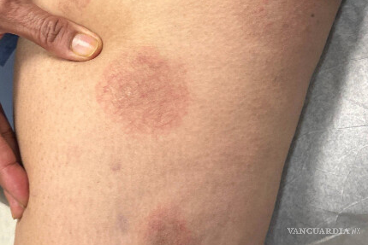 ¿Viene una epidemia de tiña?, mujer muestra de síntomas de contagiosa enfermedad