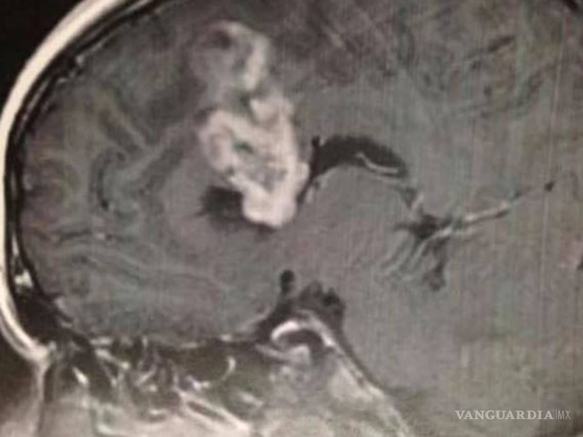 $!Un choque le salva la vida... descubren que tenía un tumor cerebral durante examen de rutina