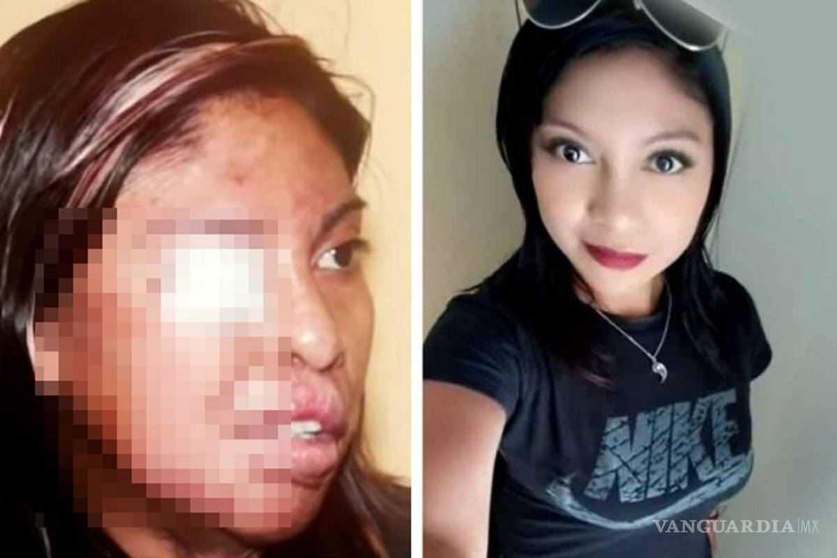 “Vas a ser mía y tienes que regresar conmigo”, su ex le arrojó ácido en la cara porque no quería volver