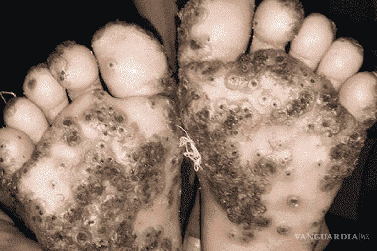Pies de niña se infectan de pulgas luego de caminar descalza en zona rural de Brasil