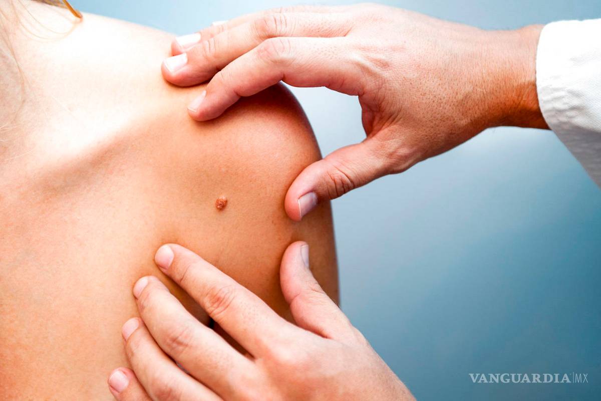 Se duplican casos de cáncer de piel en los últimos 15 años