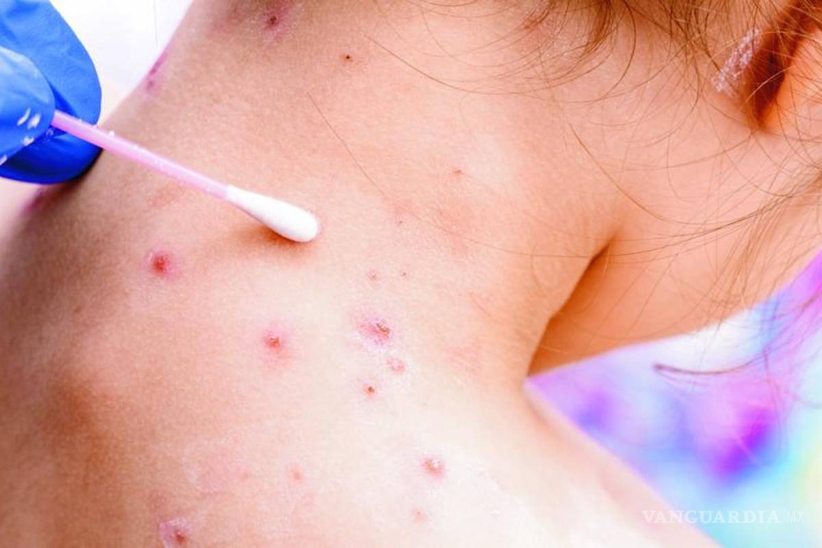 Coahuila libre de viruela del mono; descartan segundo caso sospechoso