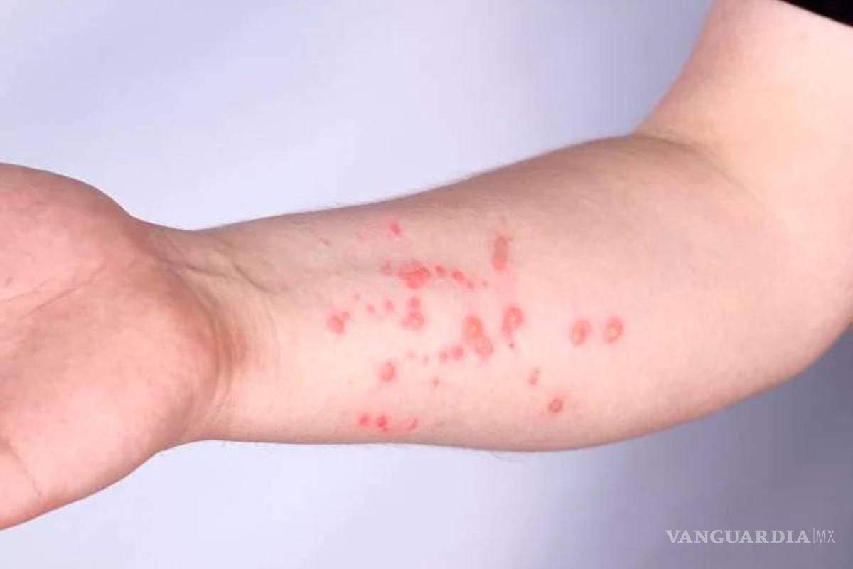 Ya son 252 casos confirmados de viruela del mono en México