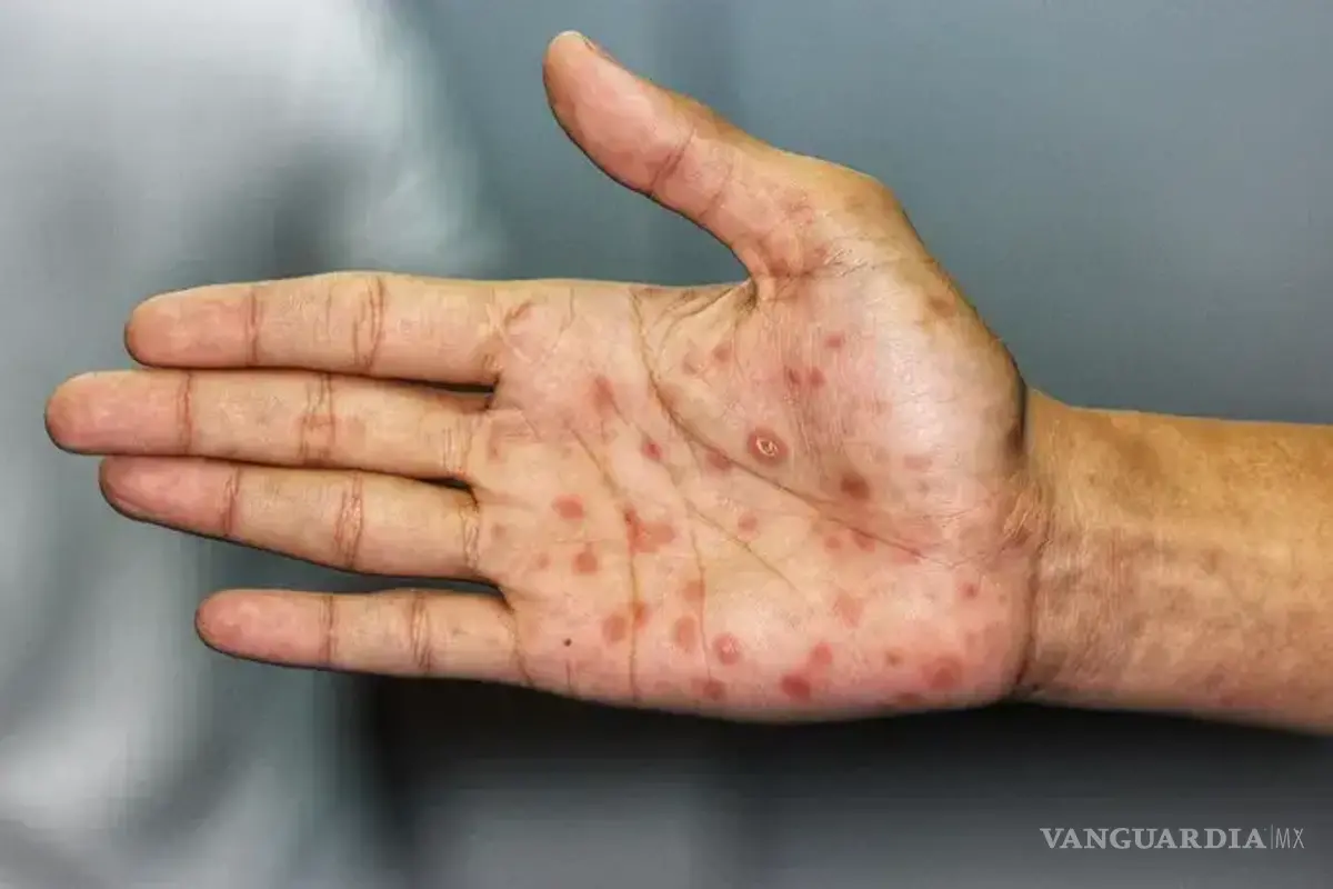 Coahuila, séptimo lugar nacional en sífilis con 1,004 casos durante 2025