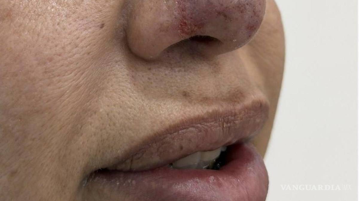 Le provocan lesiones graves en la nariz tras intervención estética, en Saltillo