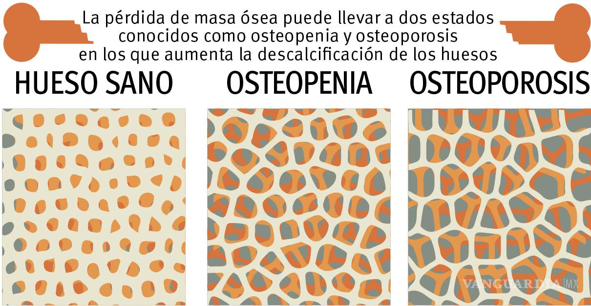 $!Osteopenia y osteoporosis: en busca de huesos fuertes