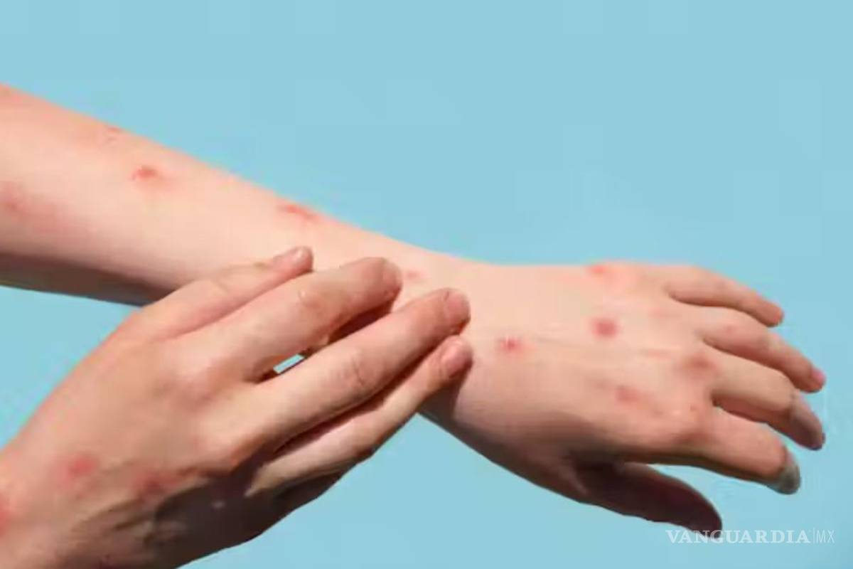 Afirma Secretaría de Salud: México no ha registrado casos de variante letal de Mpox
