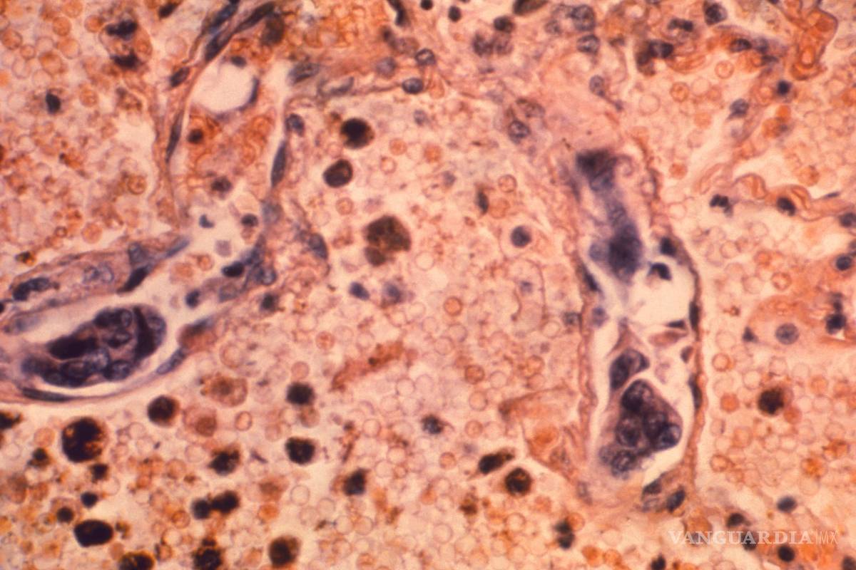 Descubren un posible tratamiento de la metástasis en cáncer