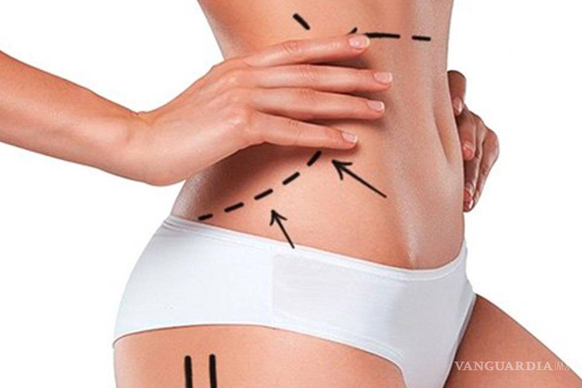 Saltillo: ofrecen tandas para lipoesculturas en redes