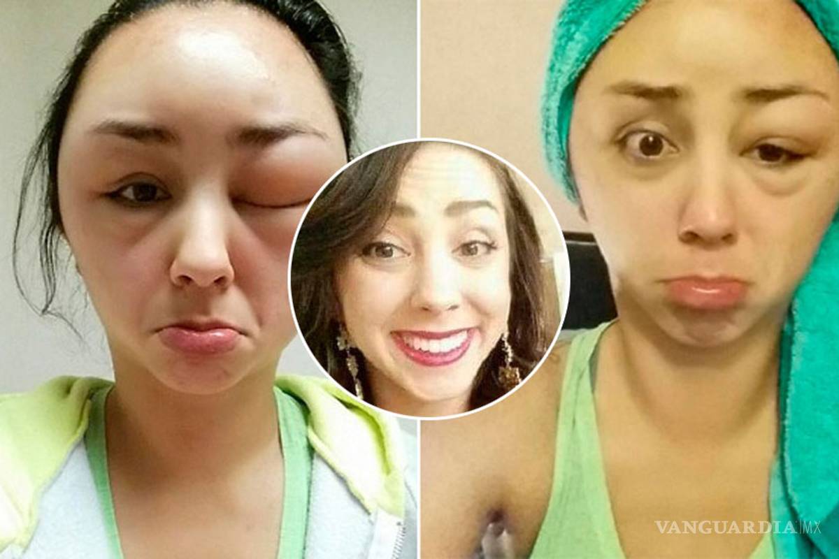 Acabó con la cara desfigurada luego de aplicarse tinte para cabello