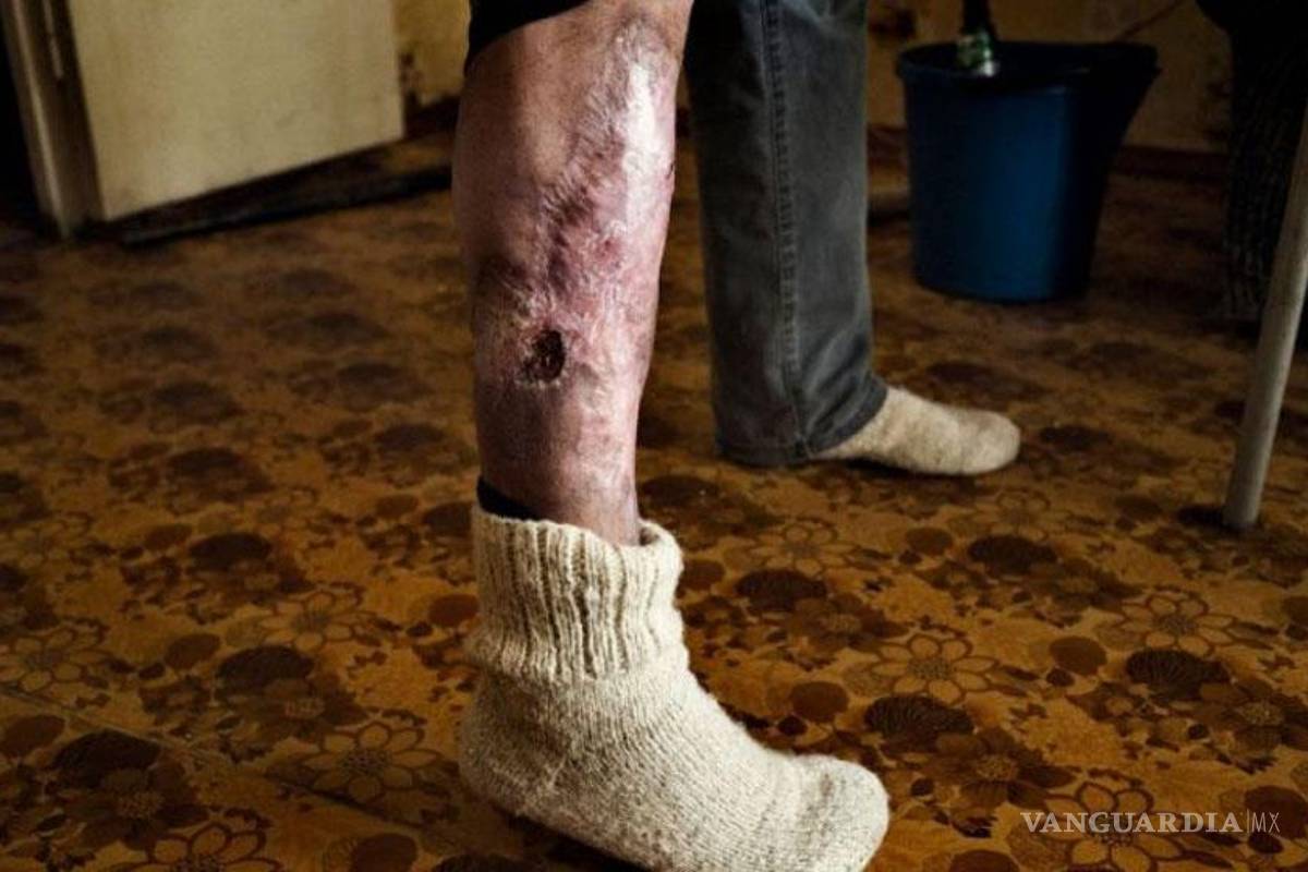 Droga Krokodil amenaza con convertirse en epidemia global