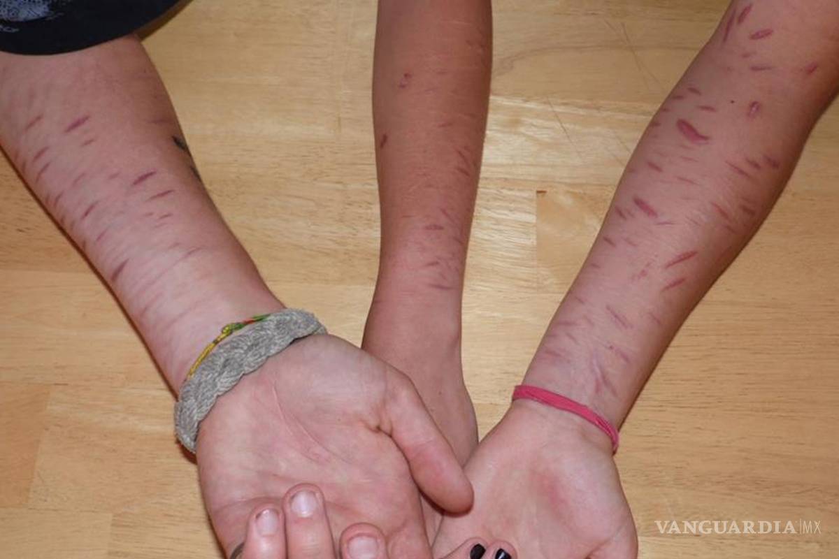 Retoma importancia casos de cutting en jóvenes estudiantes; se autolesionan