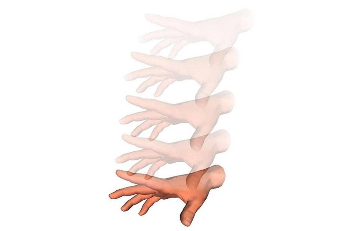 Palinopsia, la enfermedad que te hace ver la vida &quot;como en Matrix&quot;